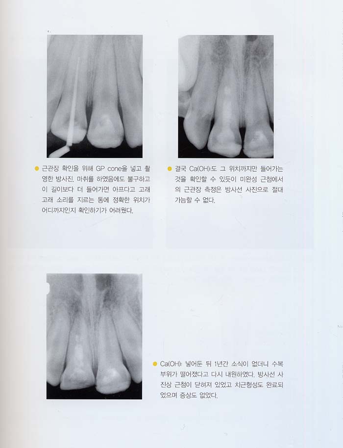 교과서에서 가르쳐주지않는 최신근관치료 II /MTA