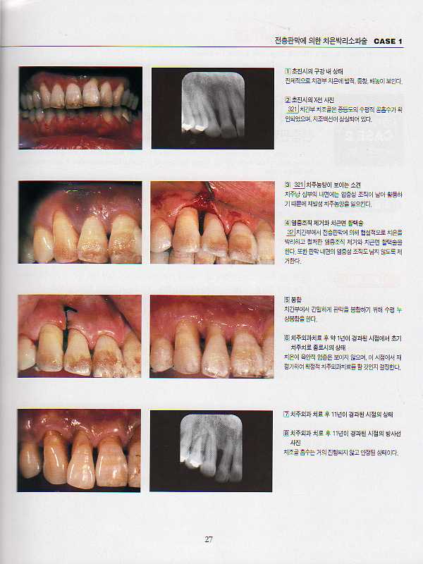 그림으로 배우는 외과적 치주치료
