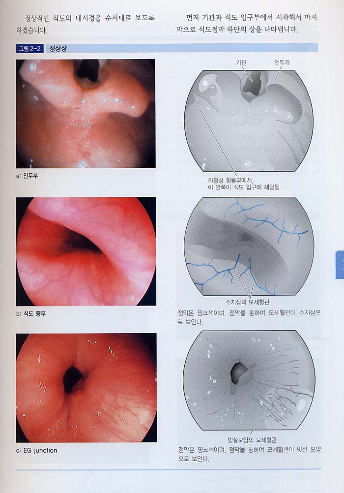 소화관 내시경 영상 판독법 - 쉽게 이해하는