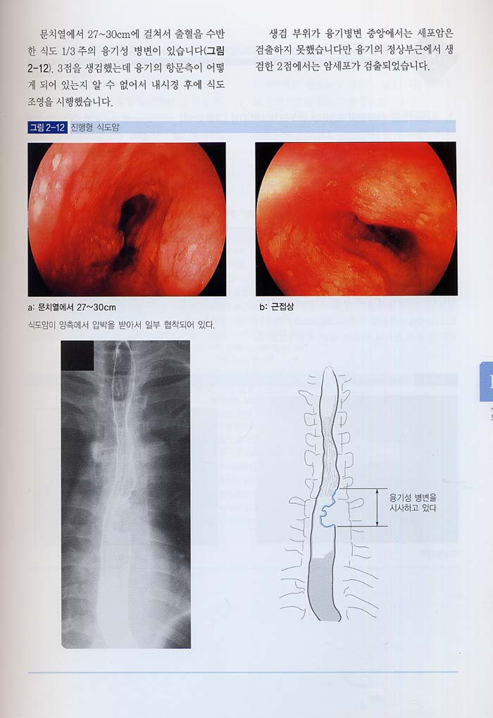 소화관 내시경 영상 판독법 - 쉽게 이해하는