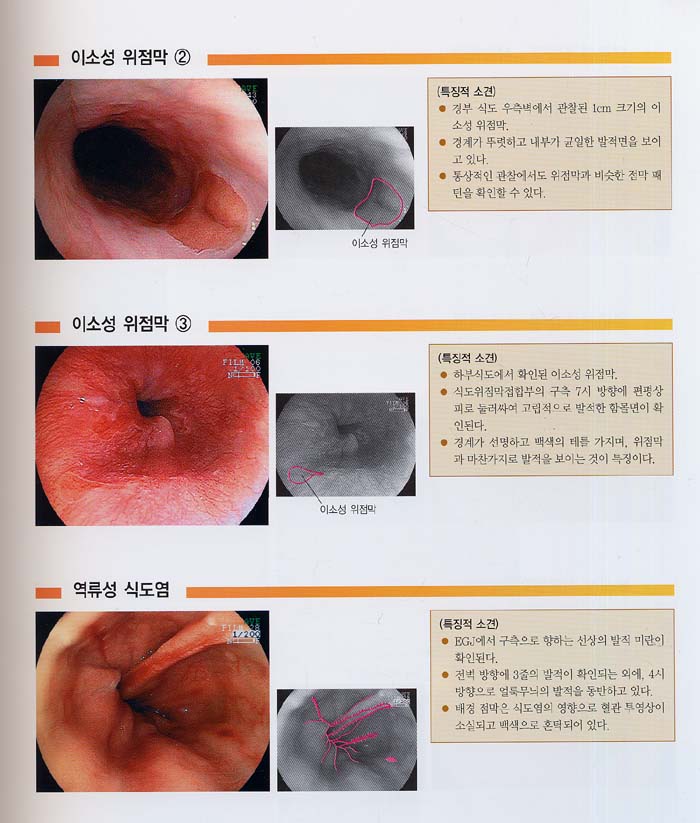 내시경진단의 요령과 질환별 내시경상 - 상부소화관-