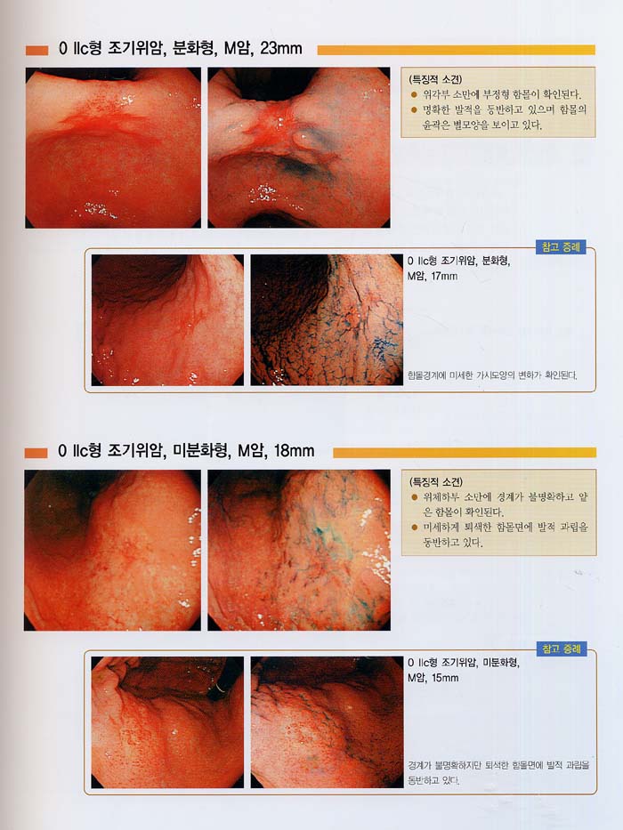 내시경진단의 요령과 질환별 내시경상 - 상부소화관-