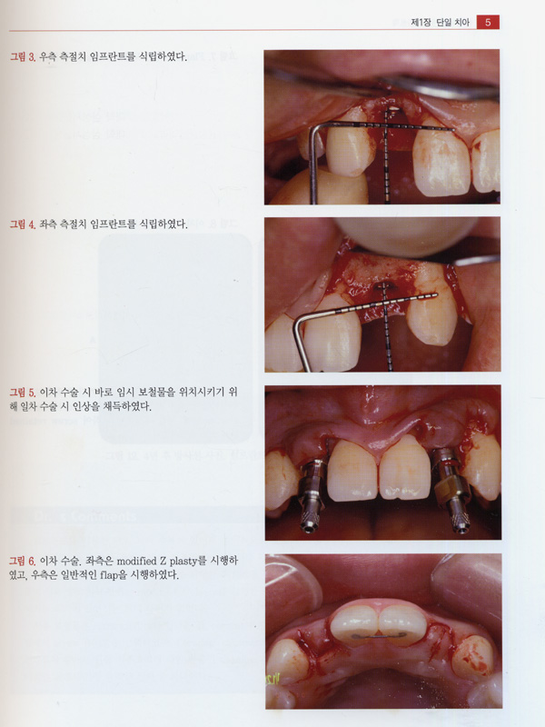 구강악안면 임프란트학 Vol.III