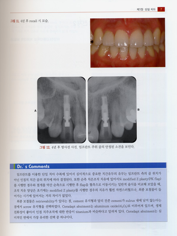 구강악안면 임프란트학 Vol.III