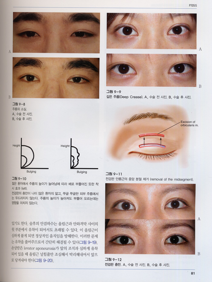 동양인의 아름다운 얼굴성형술