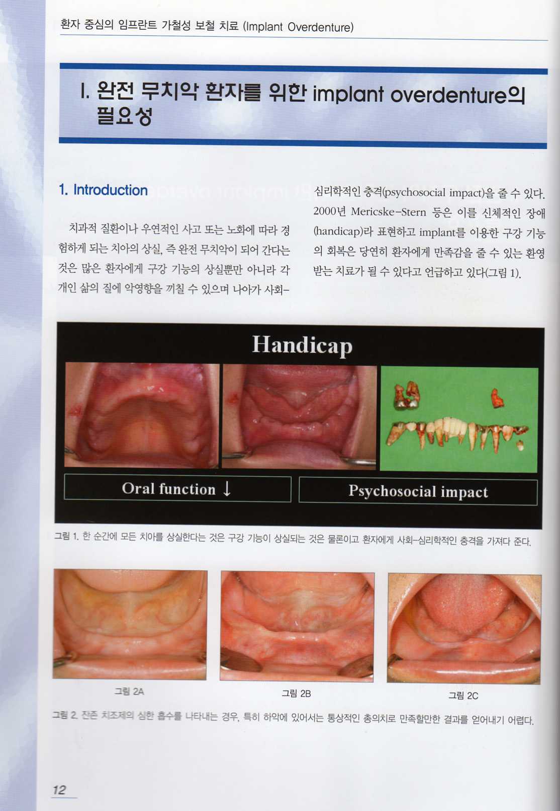 환자 중심의 임프란트 가철성 보철 치료 (implant Overdenture) 이론편 / 증례편