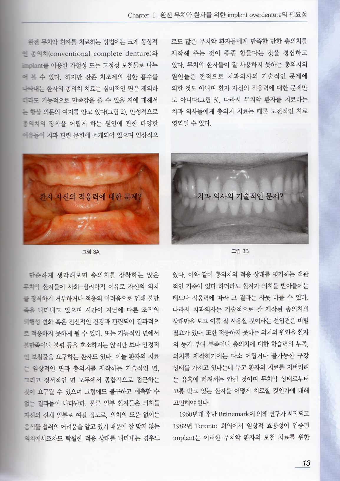 환자 중심의 임프란트 가철성 보철 치료 (implant Overdenture) 이론편 / 증례편