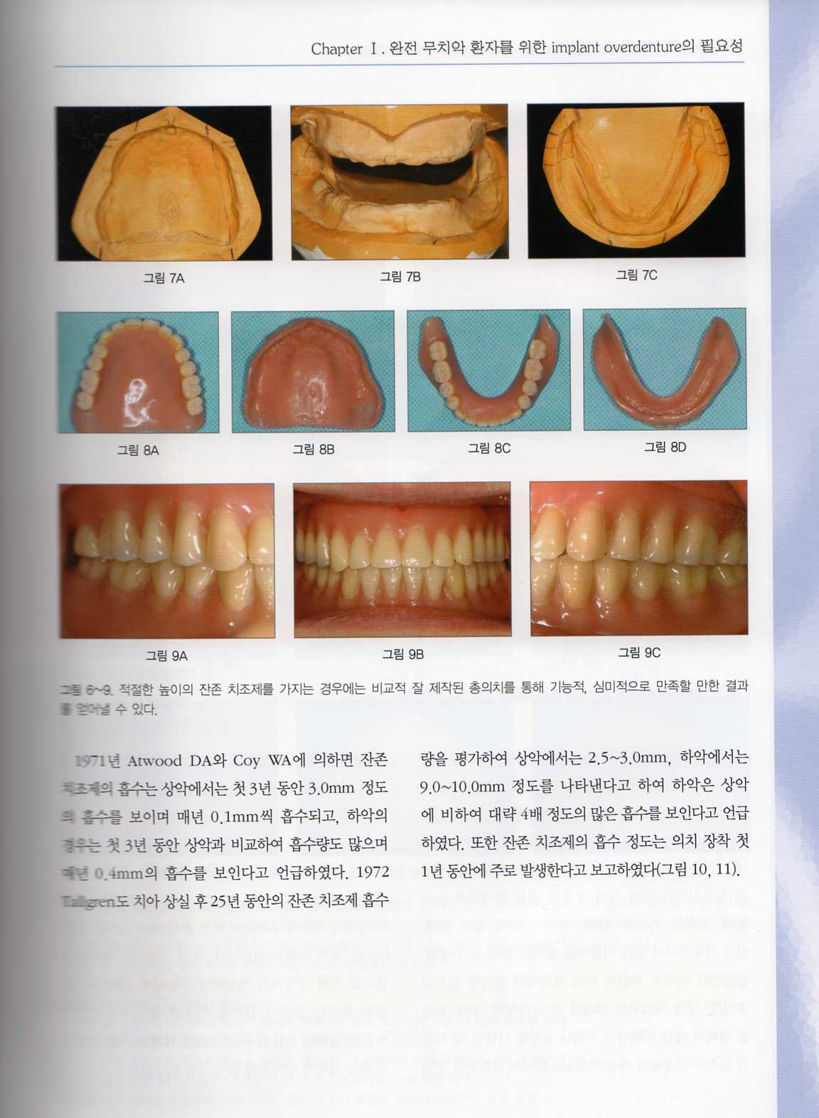 환자 중심의 임프란트 가철성 보철 치료 (implant Overdenture) 이론편 / 증례편