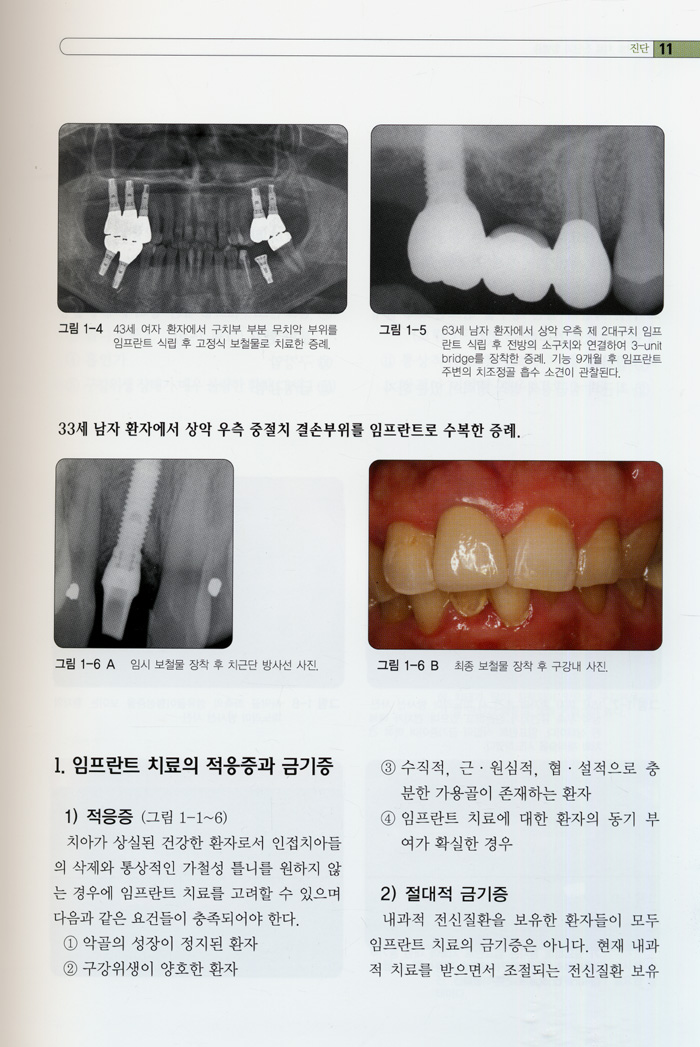 임플란트 치료계획 및 합병증 처치