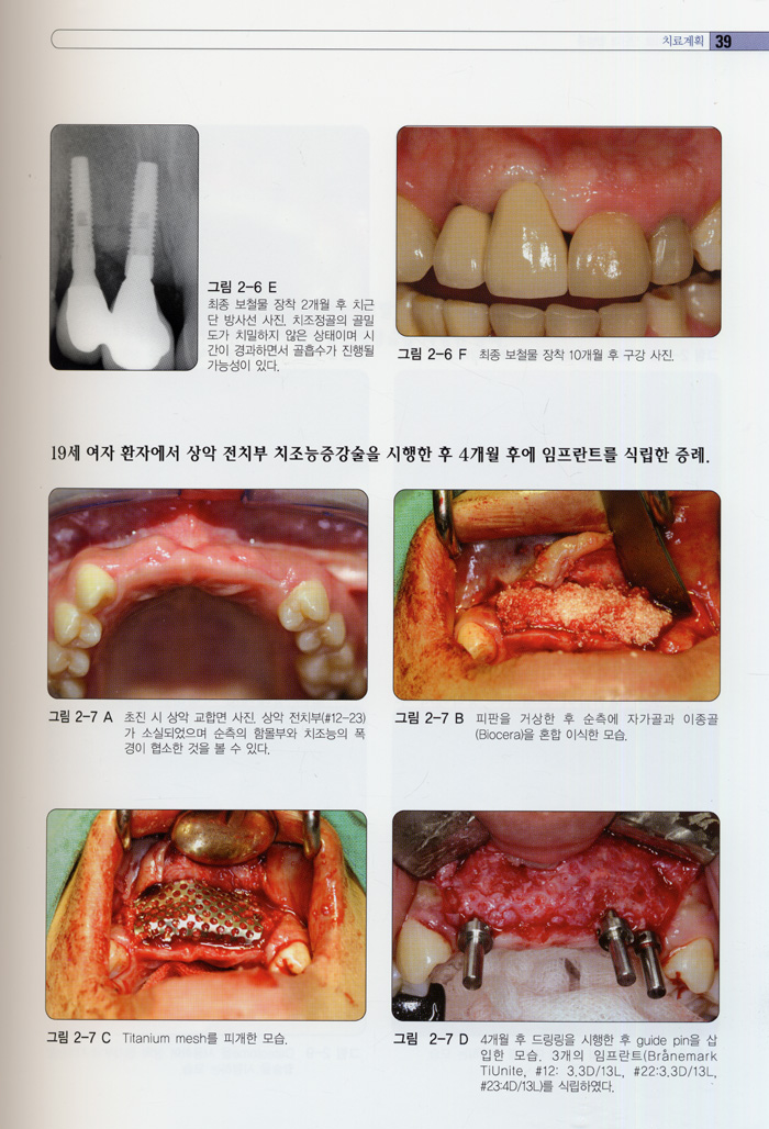 임플란트 치료계획 및 합병증 처치