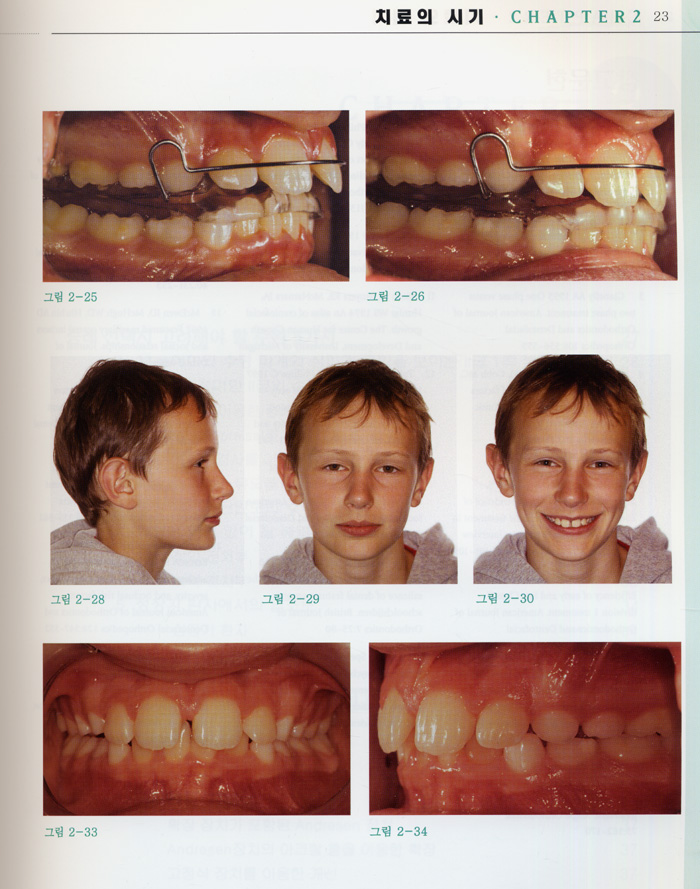 어린이(성장기) Ⅱ급Ⅰ류 부정교합의 교정치료