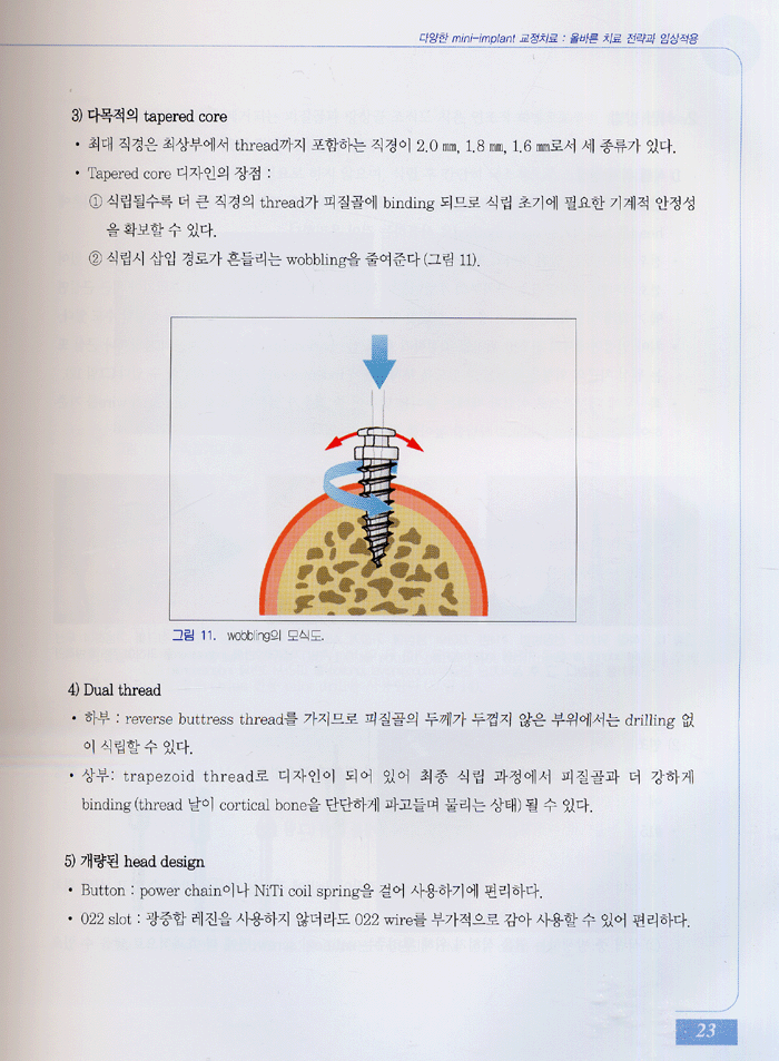 다양한 mini-implant 교정치료 - 올바른 치료 전략과 임상적용 -