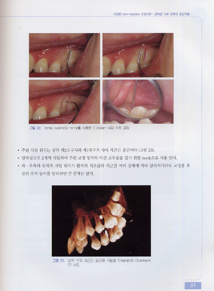 다양한 mini-implant 교정치료 - 올바른 치료 전략과 임상적용 -