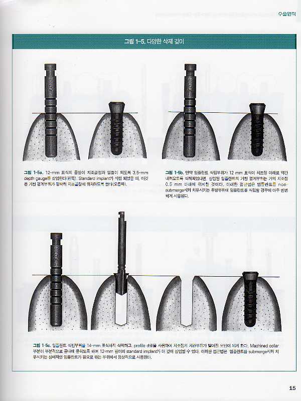 Surgical Manual of Implant Dentistry - Step-By-Step Procedures -