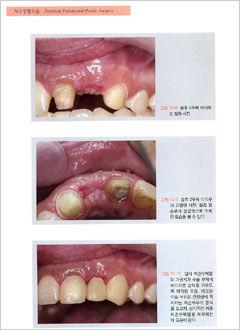 치주 성형수술