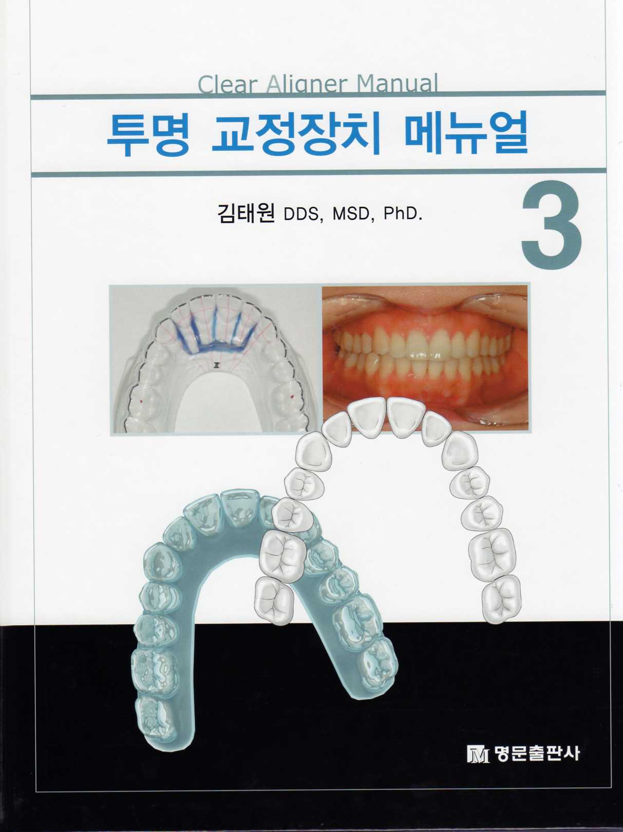 투명 교정장치 매뉴얼-Ⅲ