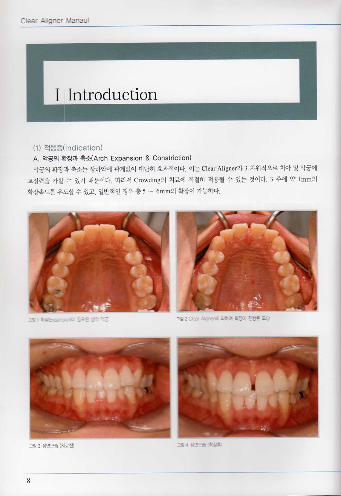 투명 교정장치 매뉴얼-Ⅲ