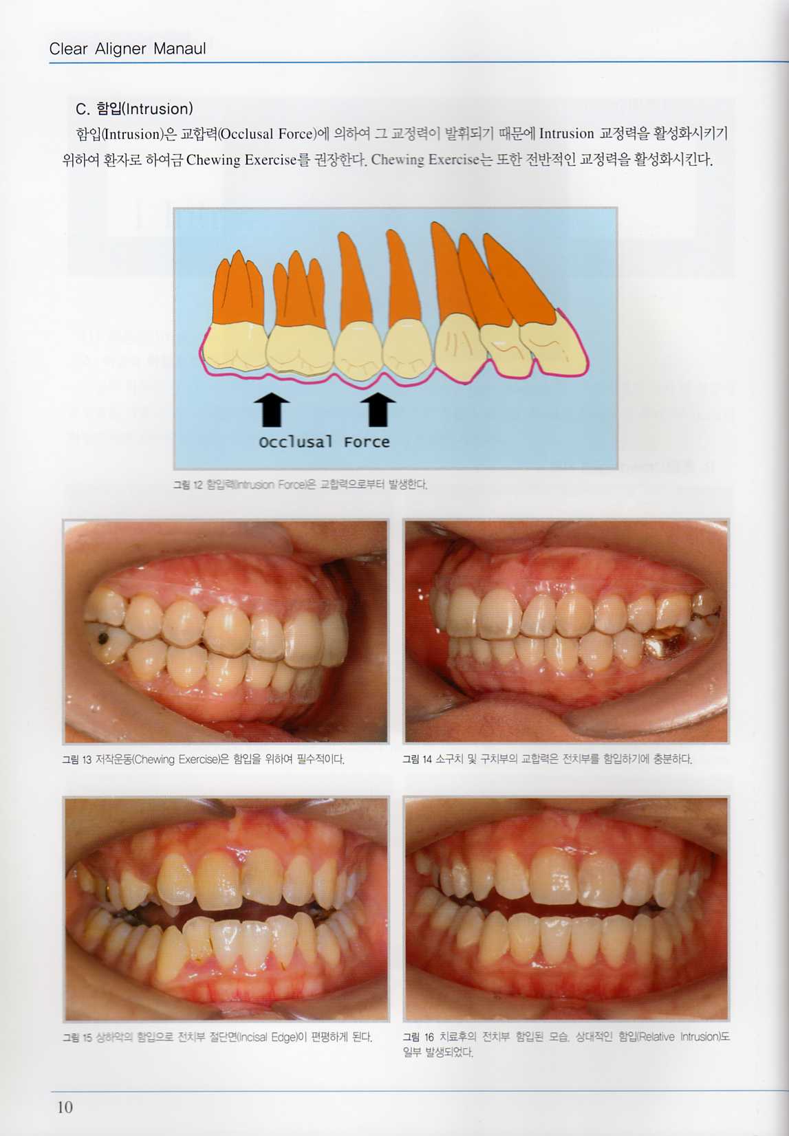 투명 교정장치 매뉴얼-Ⅲ