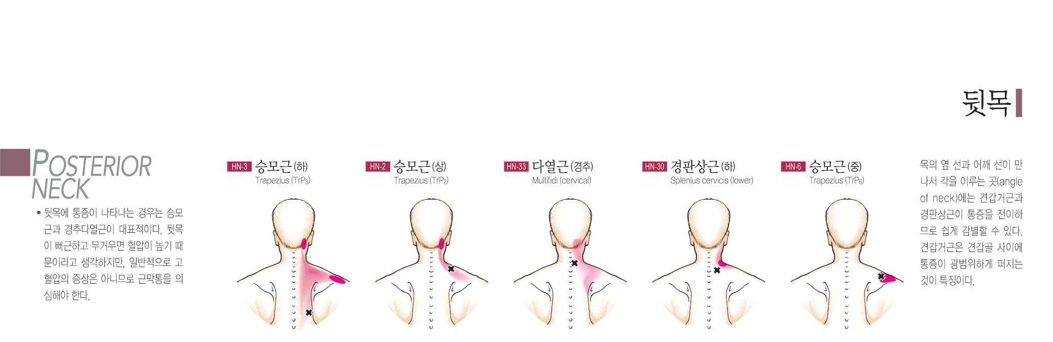 근막통 통증 차트