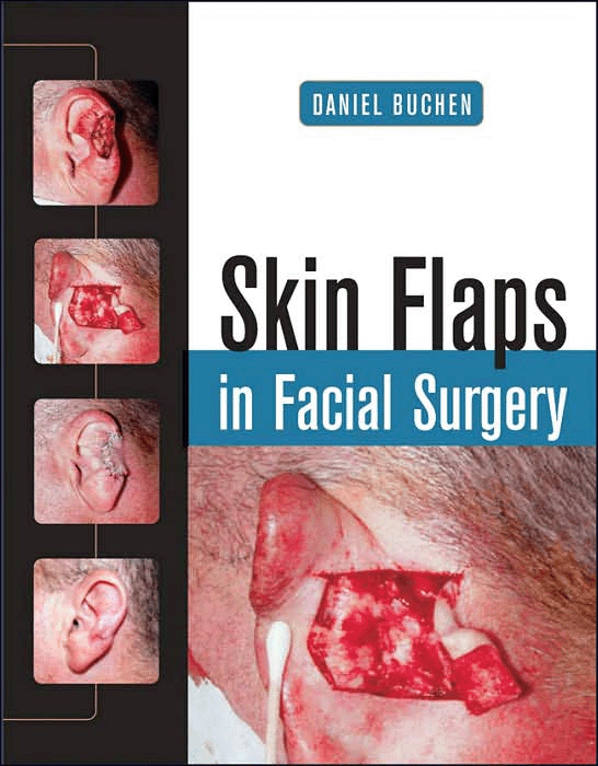 Skin Flaps in Facial Surgery