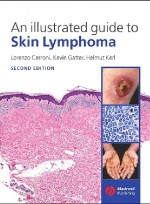 An Illustrated Guide to Skin Lymphoma, 2/e