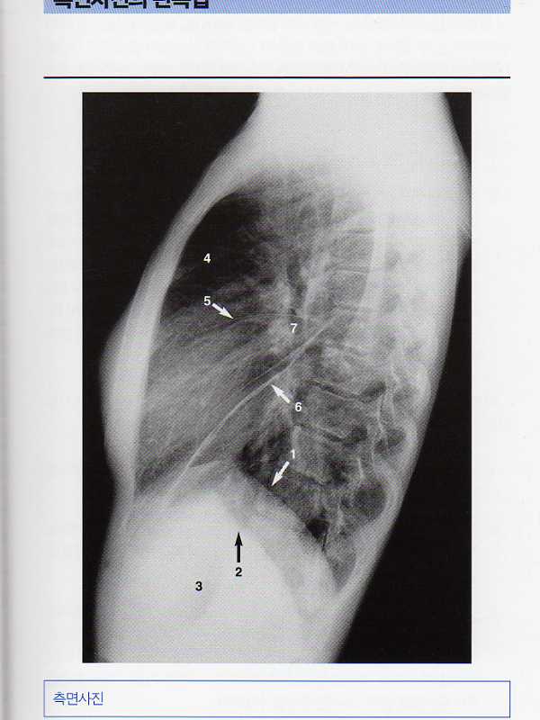 알기쉬운 흉부X선판독법