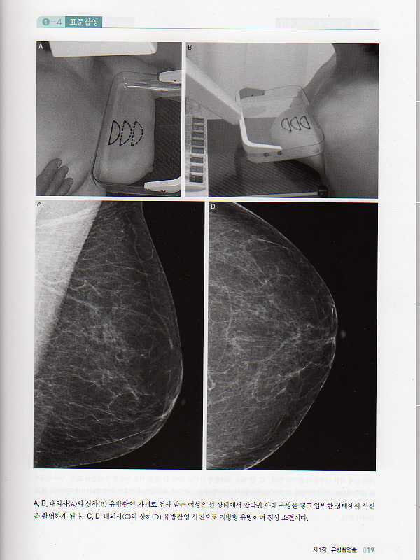 유방촬영술과 유방암의 발견 1