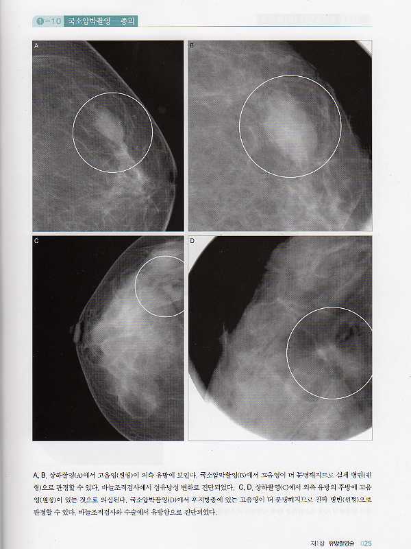유방촬영술과 유방암의 발견 1