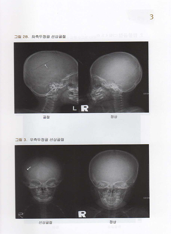 신경외과응급영상