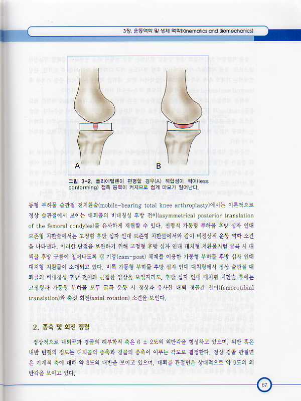 슬관절 전치환술