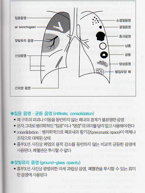 CT와 함께보는 흉부X선 아틀라스