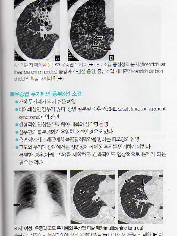 CT와 함께보는 흉부X선 아틀라스