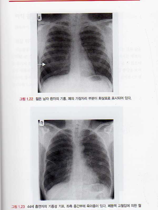 흉부X-ray의해석