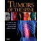 Tumors of the Spine