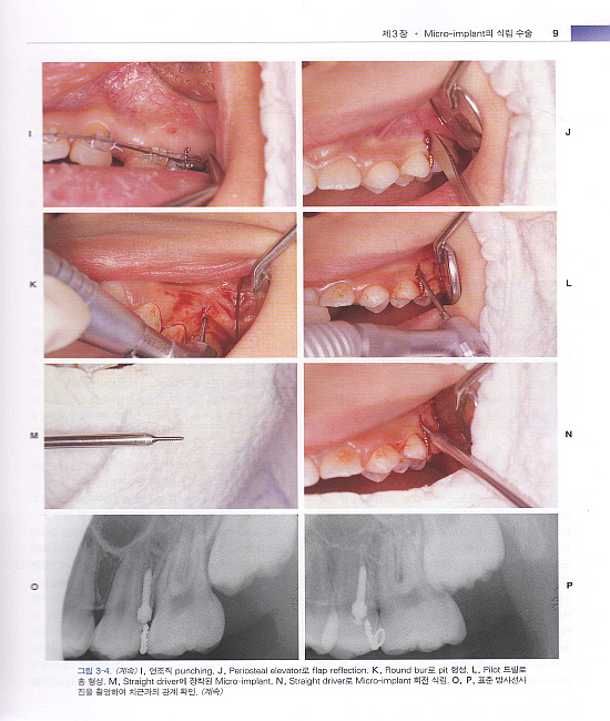 Micro-implant를 이용한 교정치료 (제2판)