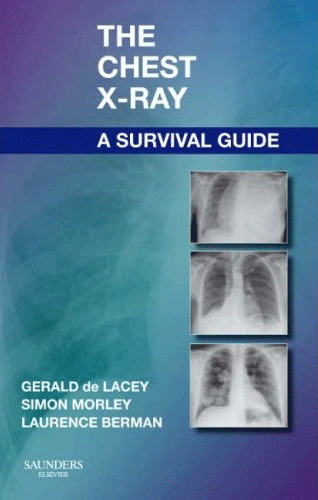 The Chest X-Ray : A Survival Guide