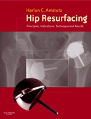 Hip Resurfacing: Principles,Indications,Technique & Results