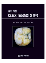 골치 아픈 Crack Tooth의 해결책[부록포함]