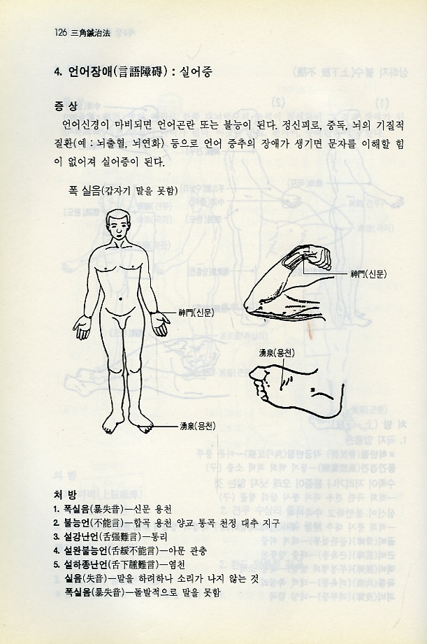 삼각침치법