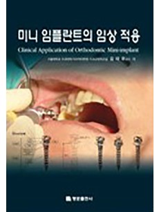 미니 임플란트의 임상적용