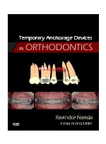 Temporary Anchorage Devices in Orthodontics