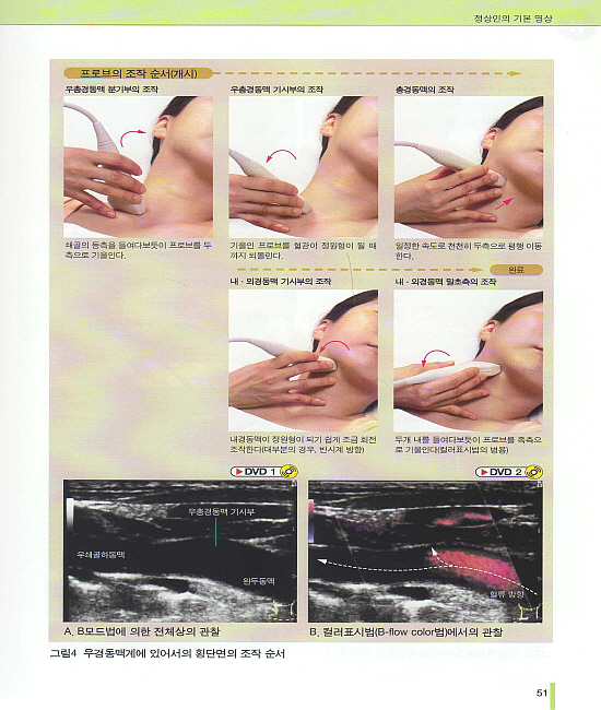 경동맥 초음파 검사 Atlas (한글자막 동영상 DVD)