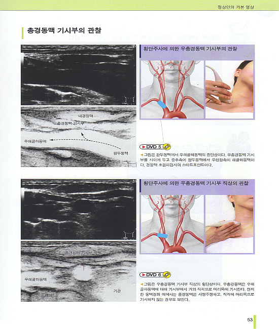 경동맥 초음파 검사 Atlas (한글자막 동영상 DVD)