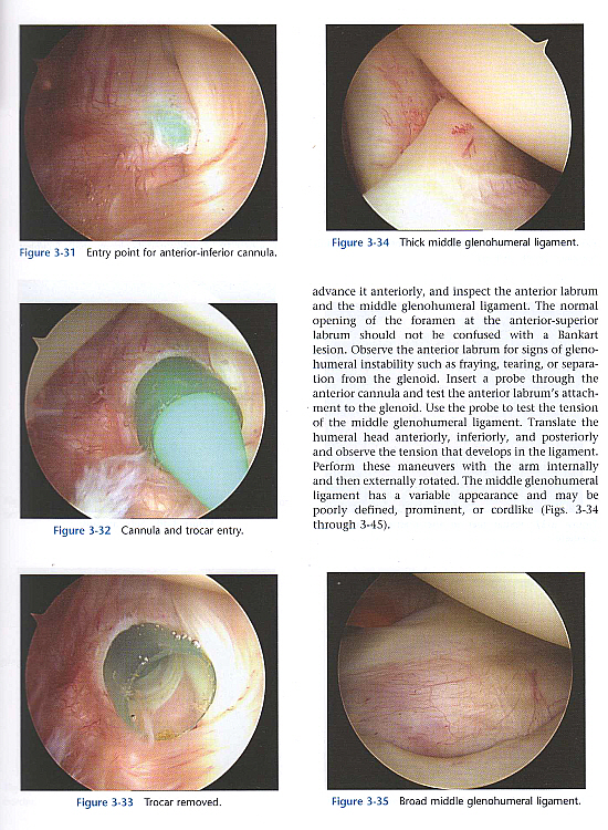 Shoulder Arthroscopy,2/e