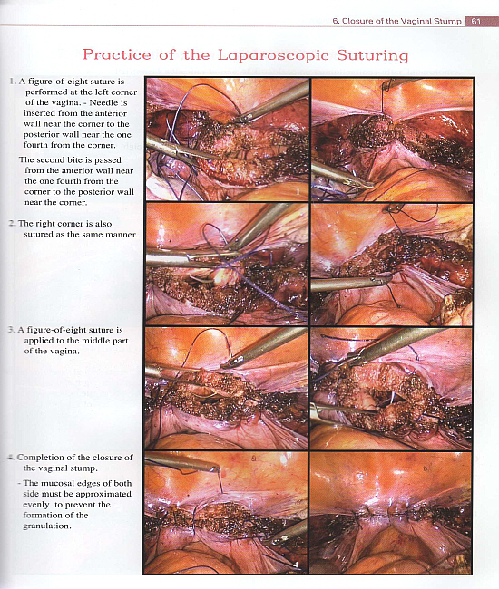 Atlas of Procedures in Laparoscopic Hysterectomy (includes DVD)