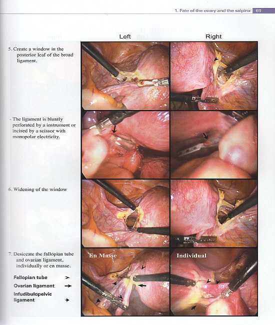 Atlas of Procedures in Laparoscopic Hysterectomy (includes DVD)