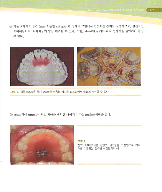 RASA의 손쉬운 제작과 적용 (resin added sheet appliance)