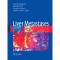 Liver Metastases