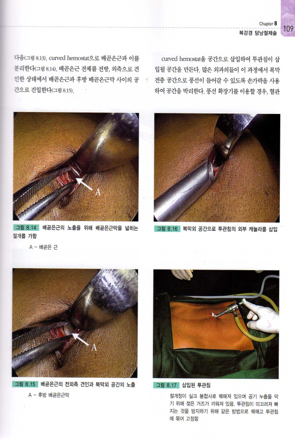 복강경 탈장수술 (Operative Manual of Laparoscopic Hernia Surgery