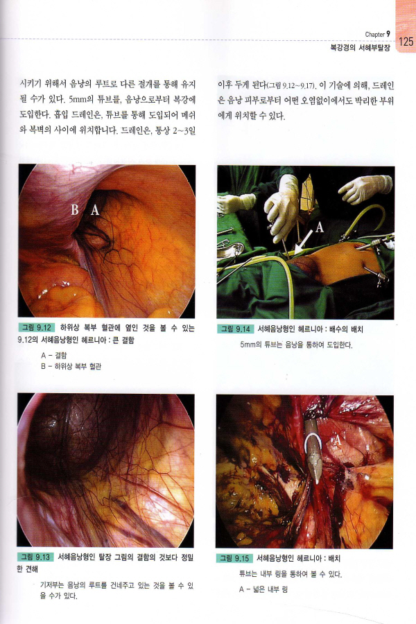 복강경 탈장수술 (Operative Manual of Laparoscopic Hernia Surgery